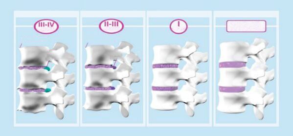 A méhnyak osteokondrózis szakaszai