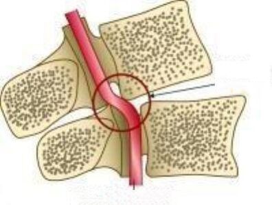 Vail artéria szindróma