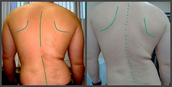 a gerinc görbülete osteochondrosissal
