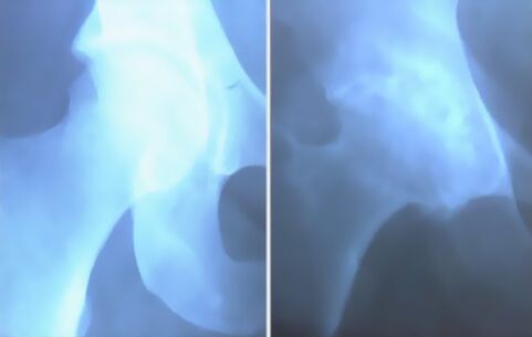 A térdízület ízületi söpredéke