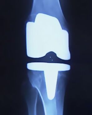 X -A térd képe mesterséges protézissel a műtét után, hogy megváltoztassa az ízületet