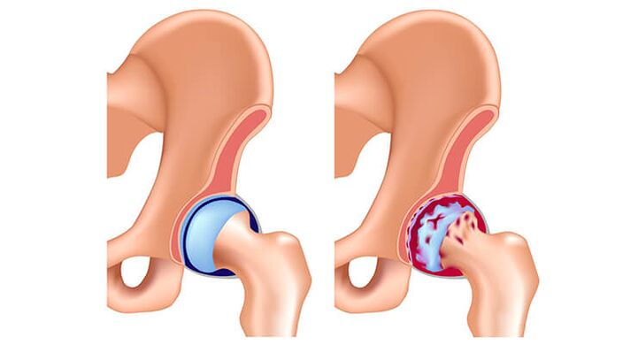 egészséges és arthrosisban érintett csípőízület