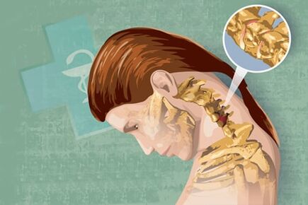 Az osteochondrosis reflex tünetei